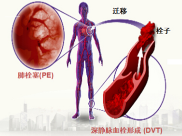 重庆远大中西结合病医院告诉你深静脉血栓会有哪些严重后果