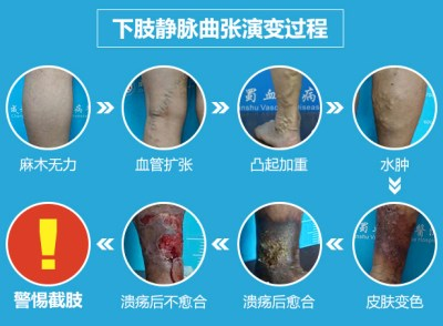 重庆远大中西结合病医院告诉你静脉曲张如何防治