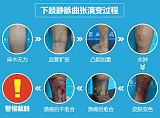 重庆远大中西结合病医院告诉你静脉曲张如何防治;