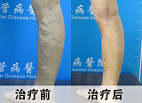 重庆远大中西结合病医院告诉你静脉曲张术后需注意哪些问题;