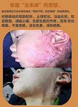 全国儿童烧烫伤疤痕案例，小孩祛疤痕zui有效方法;