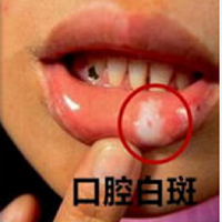 重庆北大阳光医院口腔黏膜科口腔白斑的定义