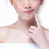 广州祛痘专业线产品1天见效温和不刺激草本萃取高效祛痘膏